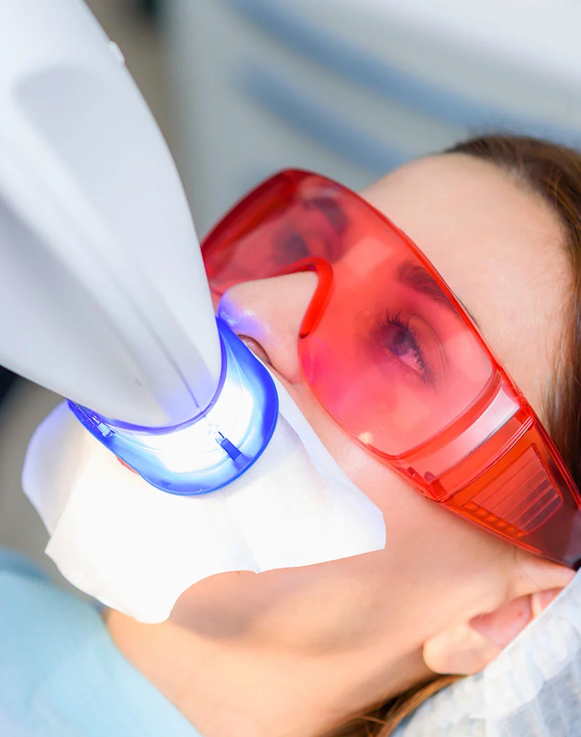 A close-up view of a patient undergoing a professional teeth whitening procedure at a dental clinic. The patient, wearing protective eyewear, has a dental whitening device positioned near their mouth, emitting a blue light. White dental materials are in place, and the patient appears relaxed during the treatment. - Teeth Whitening in Bakersfield, CA