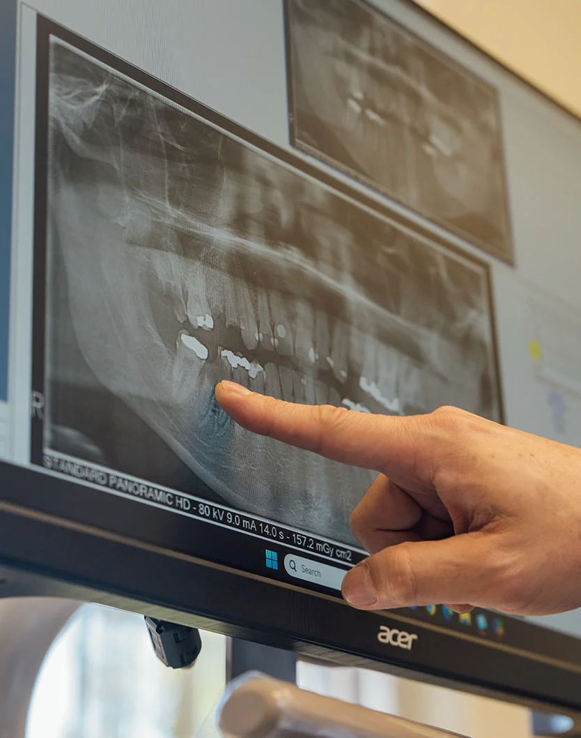 Close up of a hand pointing to an image of Dental X-rays on a computer - Digital X-Rays in Bakersfield, CA