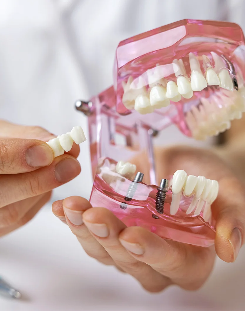 A dental professional showcasing a pink dental model with dental implants, explaining treatment options to a patient - Dental Crowns and Bridges in Bakersfield, CA